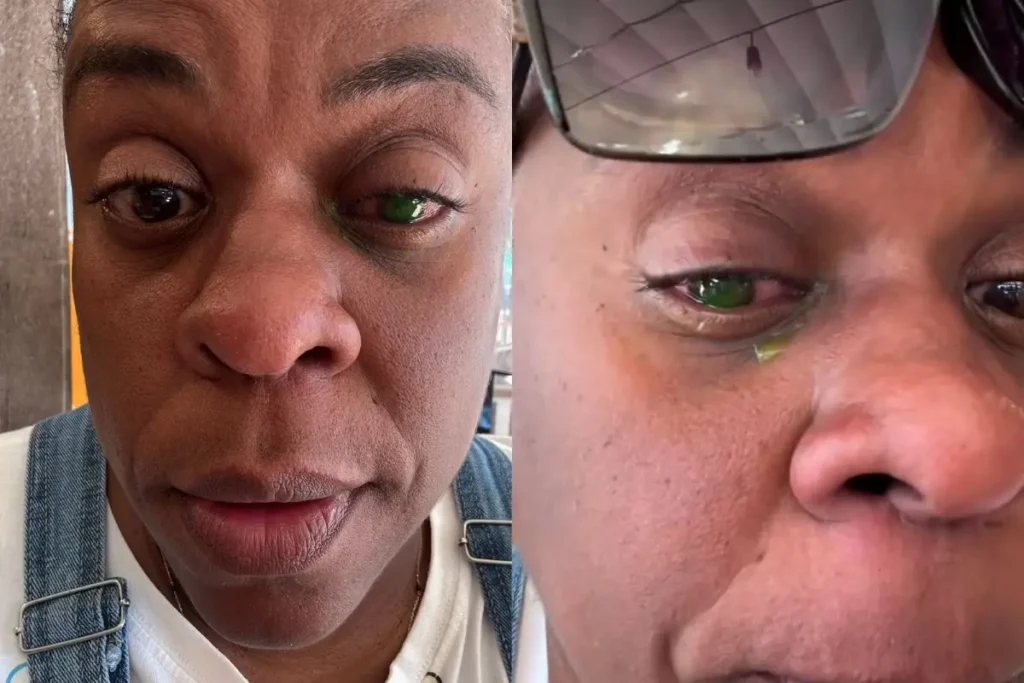Duas fotos em close-up do rosto da atriz Cacau Protásio focadas em seu olho direito, que está severamente avermelhado, inchado e lacrimejando com secreção amarelada. Ela usa um macacão jeans. Na foto da direita, óculos de sol estão apoiados na cabeça e o canto do olho está mais afetado.