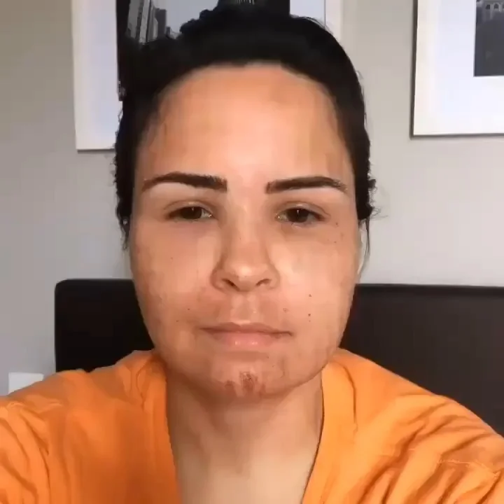 Ana Paula Renault aparece de rosto limpo, sem maquiagem, exibindo manchas e marcas avermelhadas na pele do rosto e queixo. Ela está com os cabelos presos e veste uma camiseta laranja em um ambiente interno.