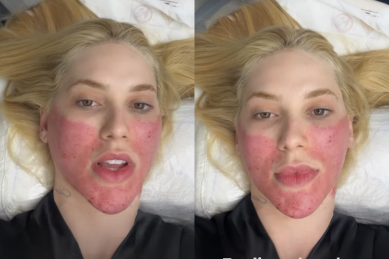 Virginia Fonseca deitada em uma maca de procedimento estético, com as bochechas e o queixo apresentando intensa vermelhidão e marcas de agulhas após tratamento facial. Ela possui cabelos loiros espalhados sobre o travesseiro e veste um roupão preto.