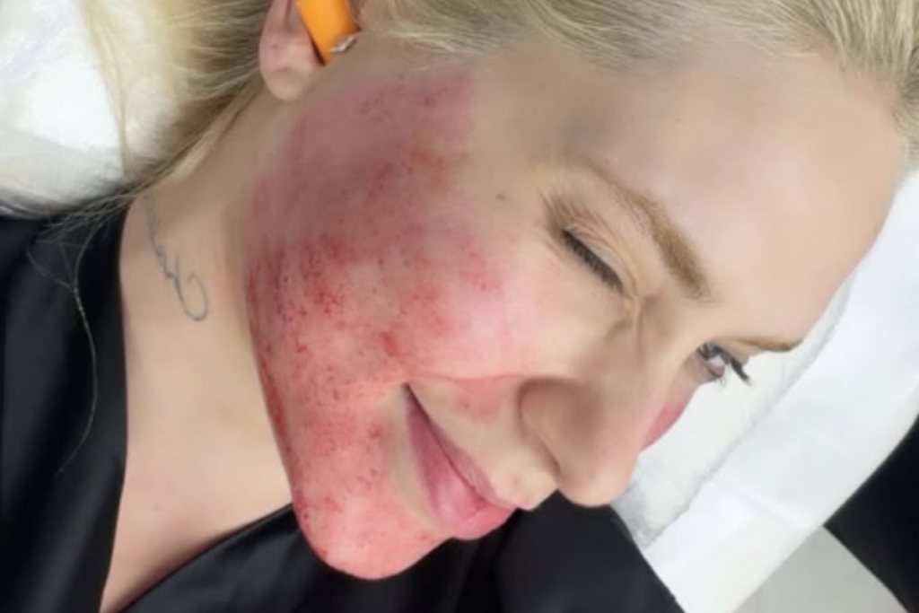 Close lateral do rosto de Virginia Fonseca, mostrando detalhadamente a pele avermelhada e com marcas de agulhas após um procedimento estético. Ela está com os olhos fechados, deitada, e é possível ver parte de uma tatuagem no pescoço e seu roupão preto.
