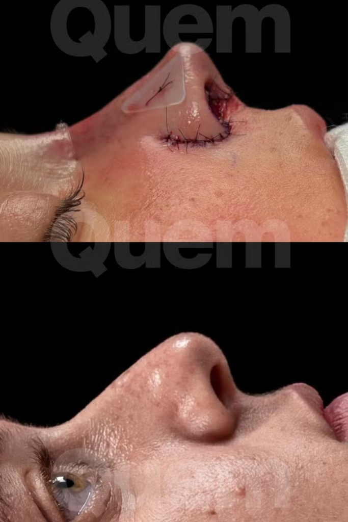 Montagem comparativa mostrando o perfil do rosto de Rafa Justus. Na imagem superior, o nariz apresenta pontos cirúrgicos e curativos logo após um procedimento; na imagem inferior, o nariz aparece totalmente cicatrizado e com novo formato.