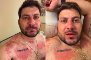 Homem adulto com barba, identificado como Caio Afiune, apresentando manchas vermelhas e placas extensas de irritação na pele do rosto, pescoço e peito devido a uma reação alérgica.