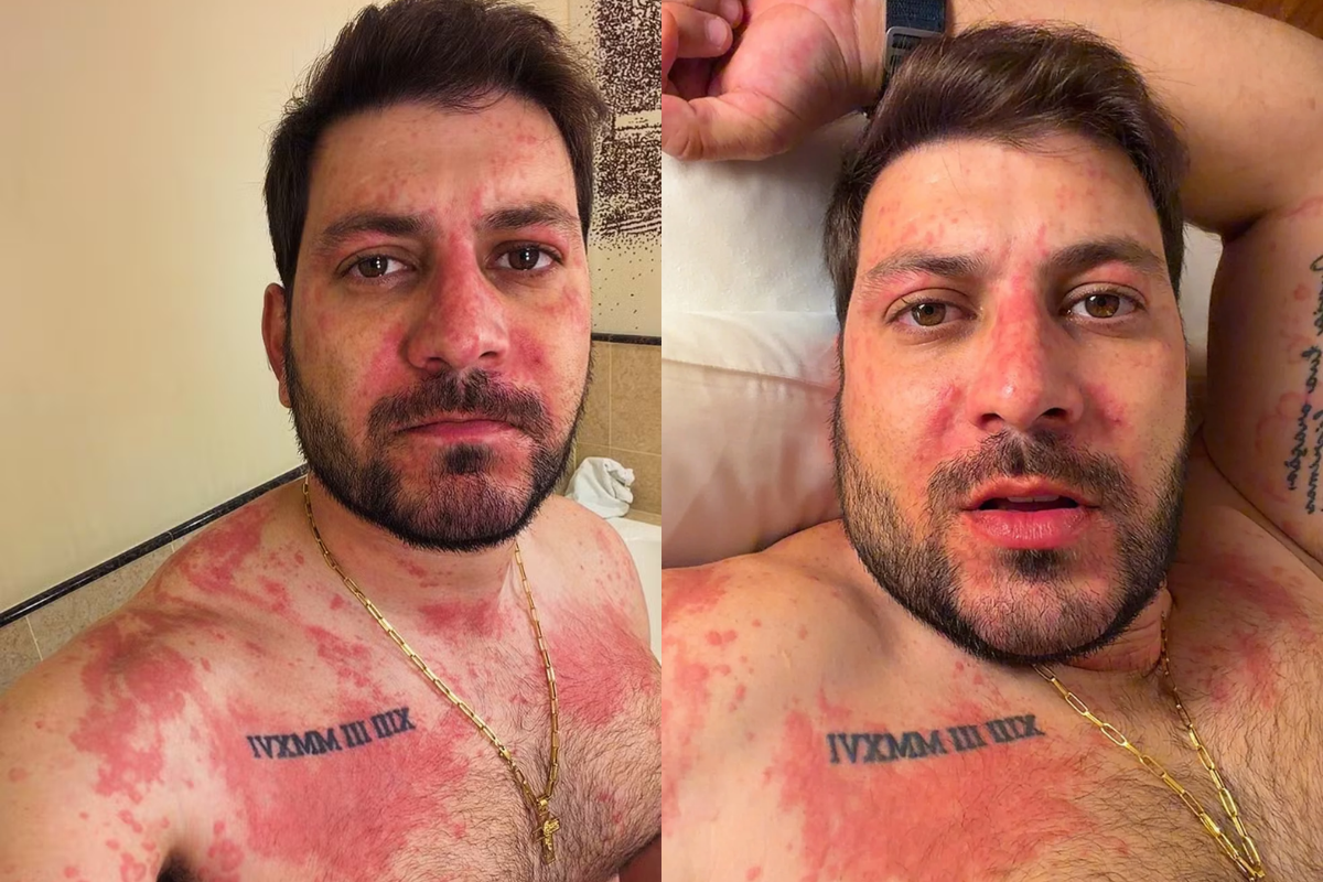 Homem adulto com barba, identificado como Caio Afiune, apresentando manchas vermelhas e placas extensas de irritação na pele do rosto, pescoço e peito devido a uma reação alérgica.