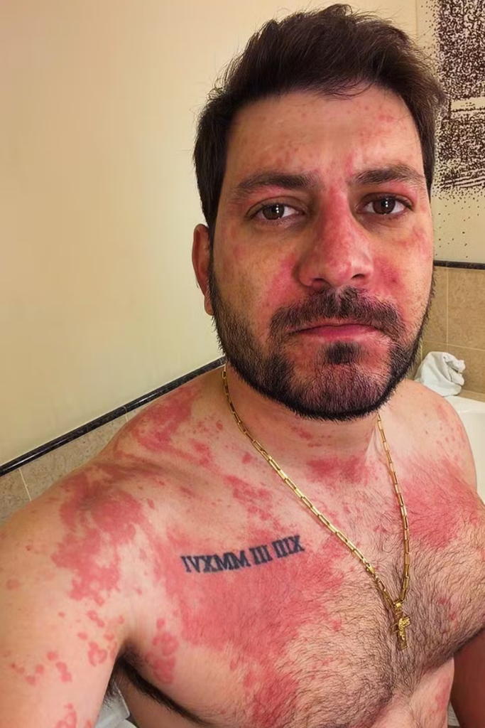 Close-up do ex-BBB Caio Afiune com expressão séria, apresentando manchas vermelhas e placas de irritação cutânea severa no rosto e no peito.