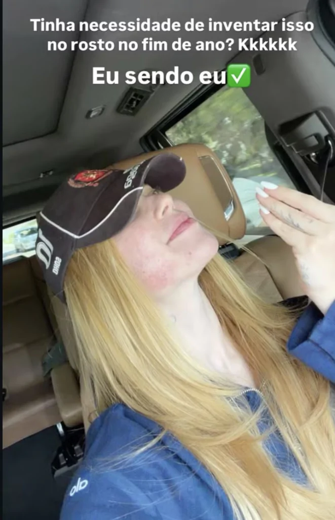 Post feito por Virginia Fonseca sobre procedimento na pele