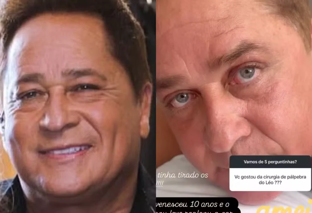 Antes e depois de blefaroplastia de Leonardo